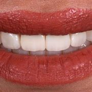 DESIGNING A PRIDE SMILE