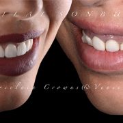 Gummy smile and POWER of Temporary crowns