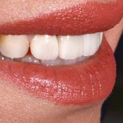 DESIGNING A PRIDE SMILE