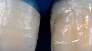 A natural-looking composite restoration: when Science meets Practice (Jeddah)